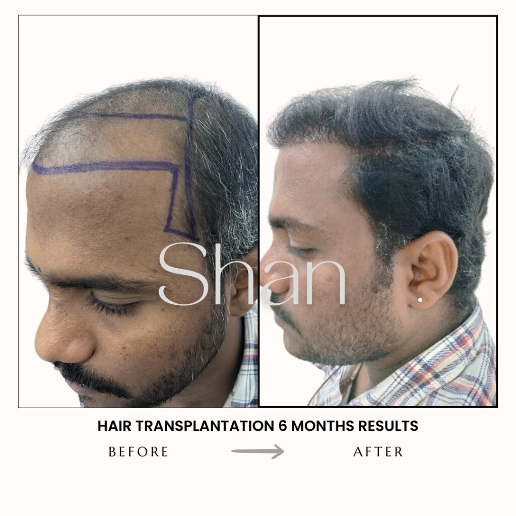 Hair Transplant