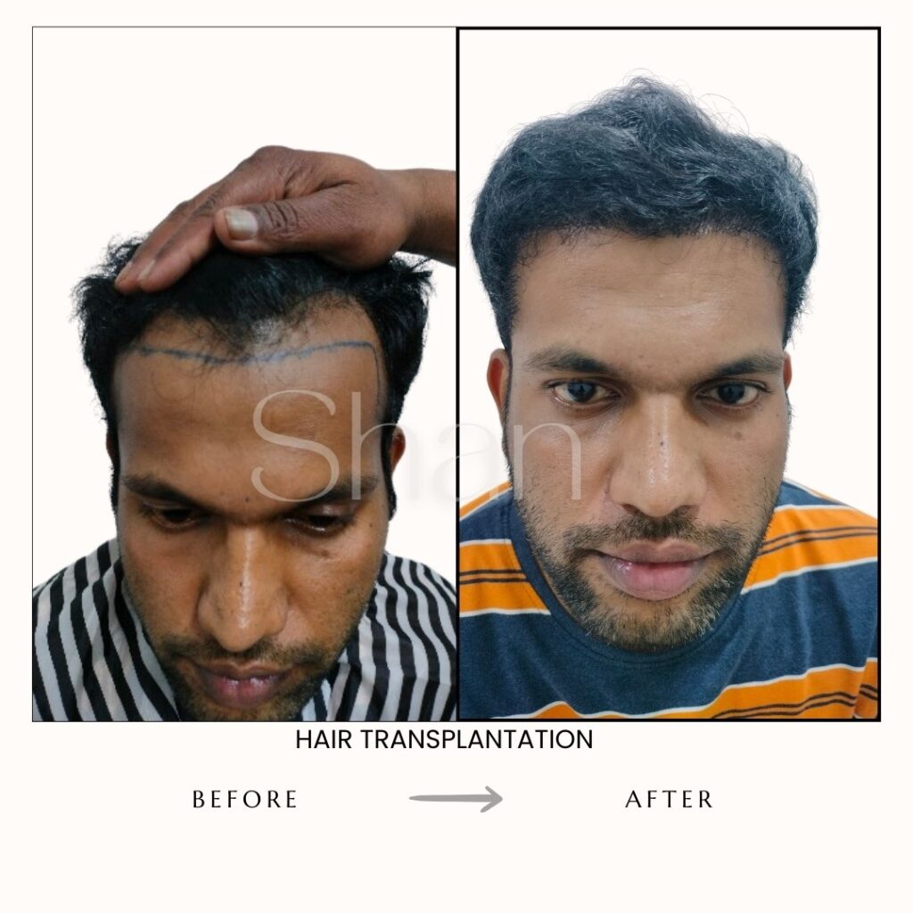 Hair Transplant