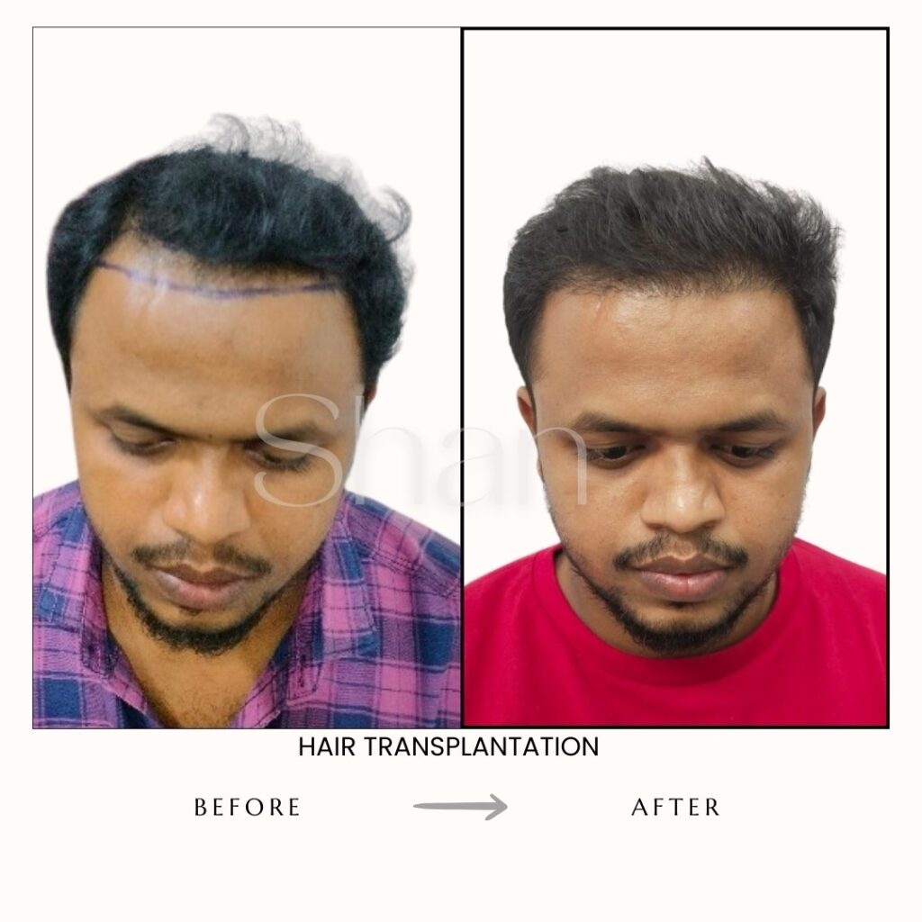 Hair Transplant