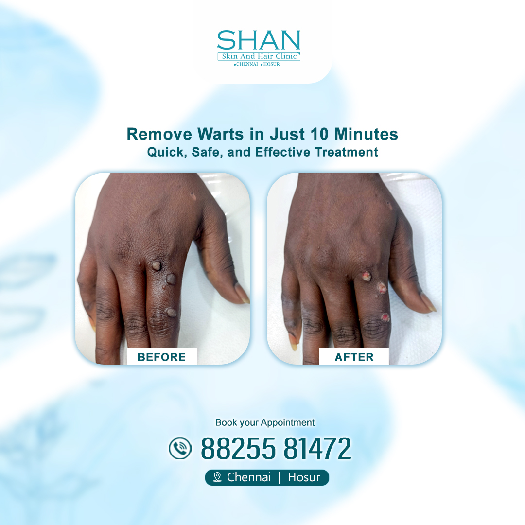 Wart Removal Treatment