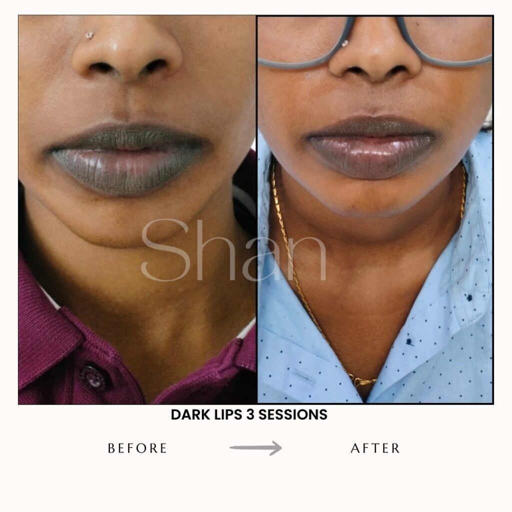 Dark Lip Treatment