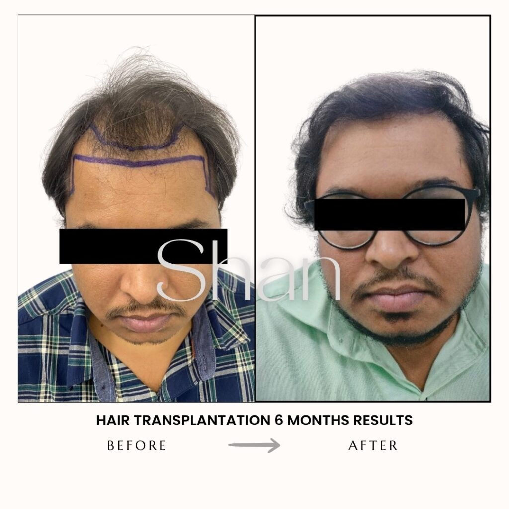 Hair Transplant
