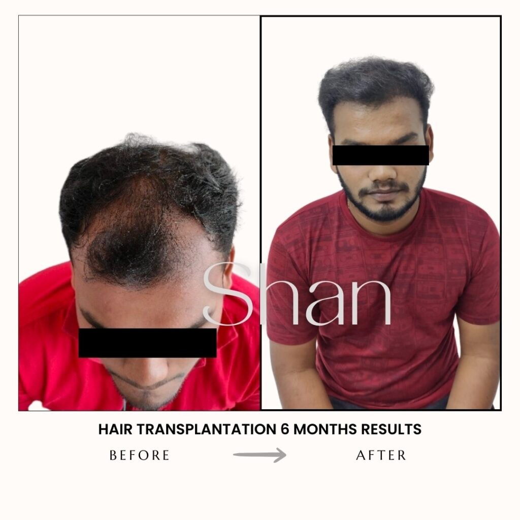 Hair Transplant