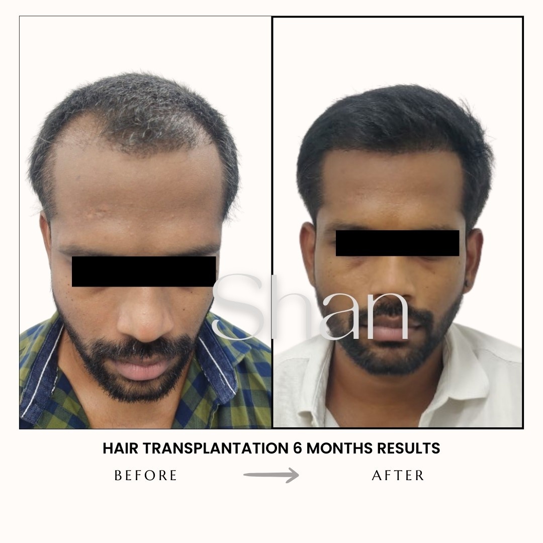 Hair Transplant