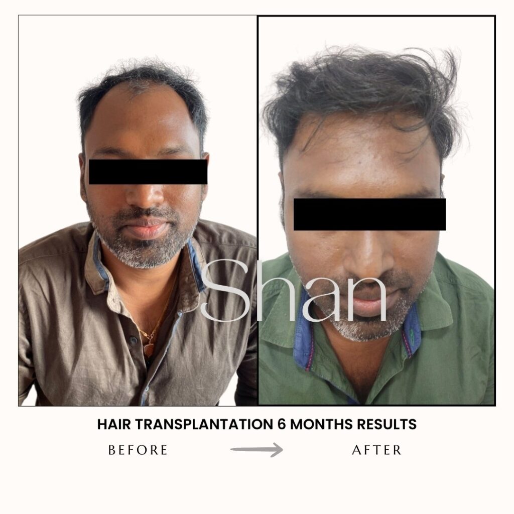 Hair Transplant