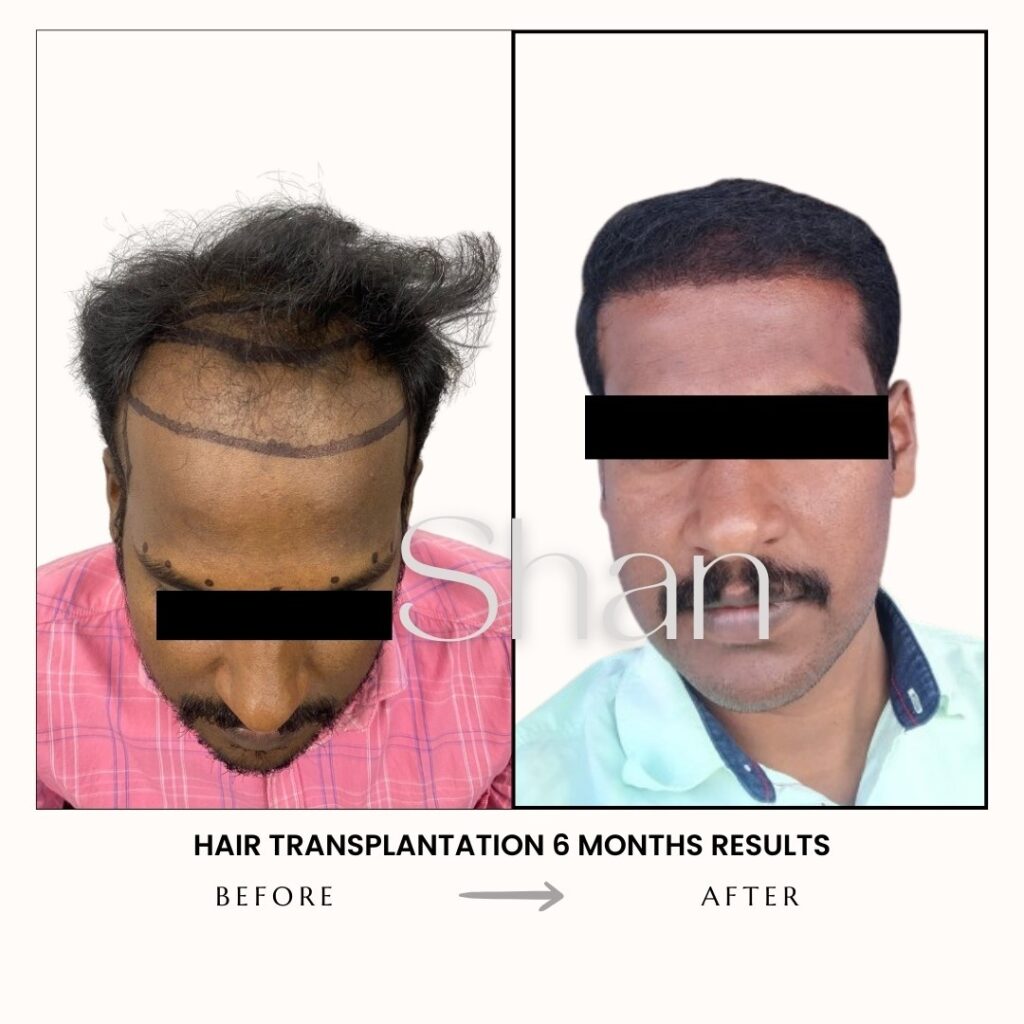Hair Transplant