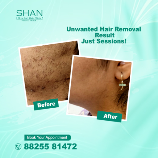 Laser Hair Removal