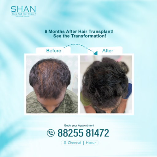 Hair Transplant